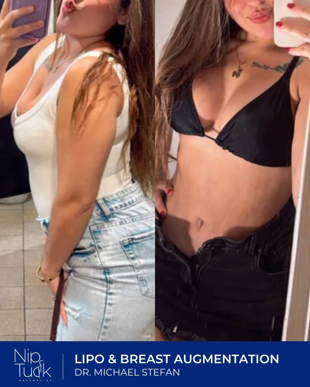 Breast Augmentation result by Dr. Michael Stefan