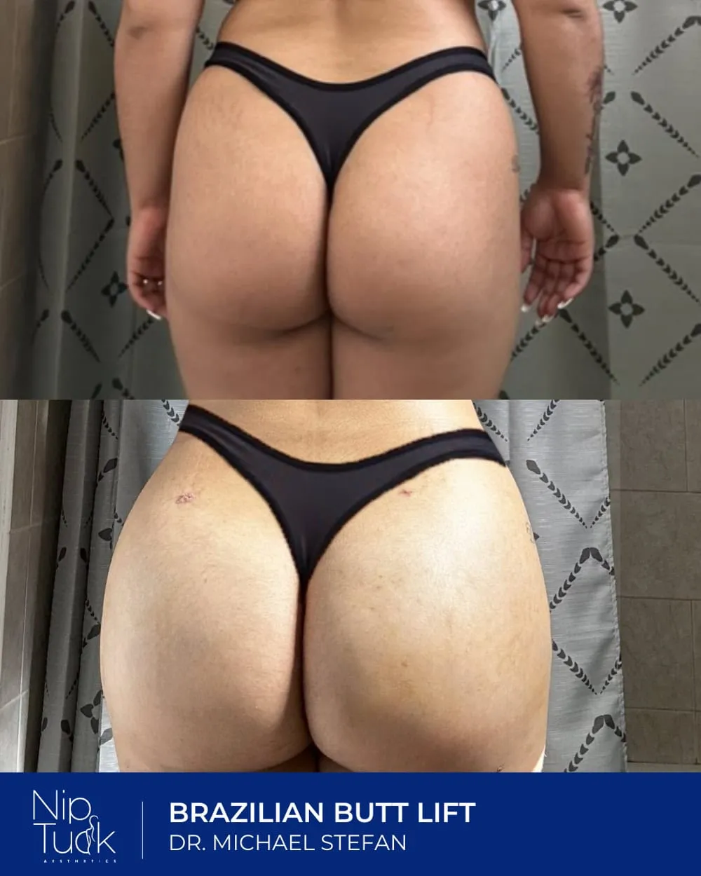 Brazilian Butt Lift result by Dr. Michael Stefan
