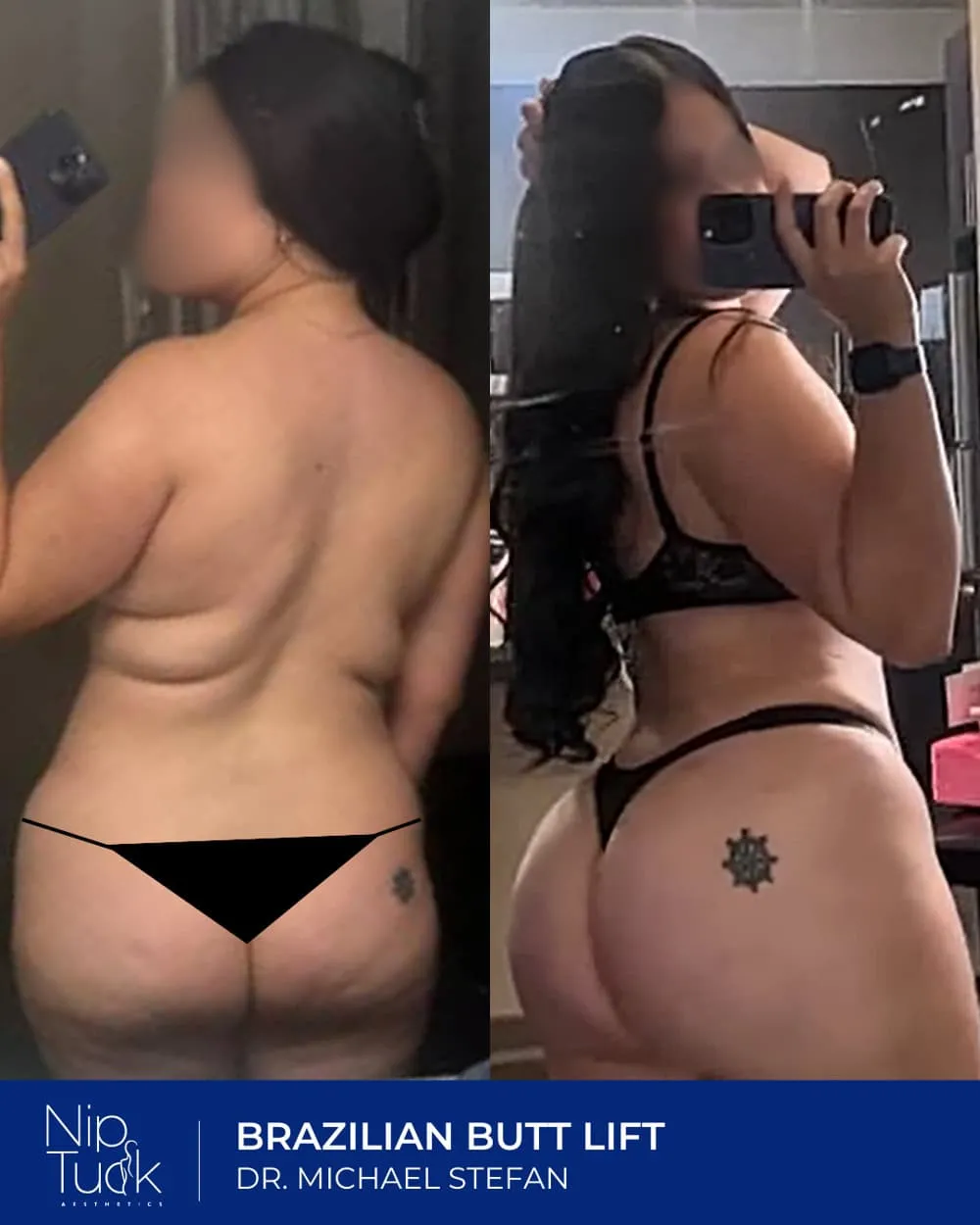 Brazilian Butt Lift result by Dr. Michael Stefan