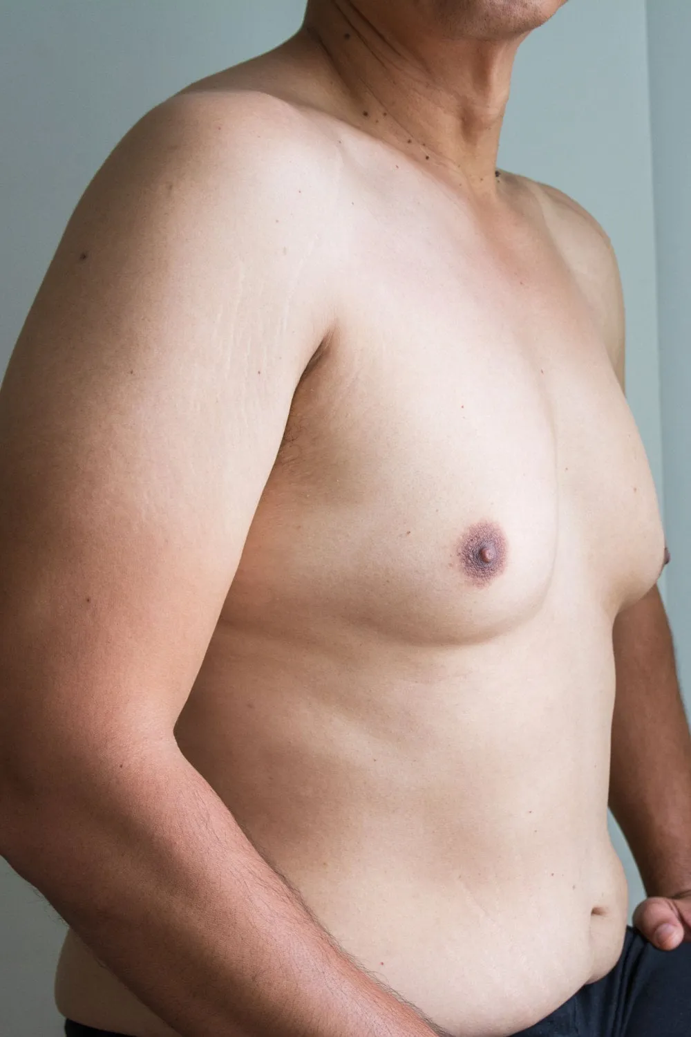 Gynecomastia Surgery Miami
