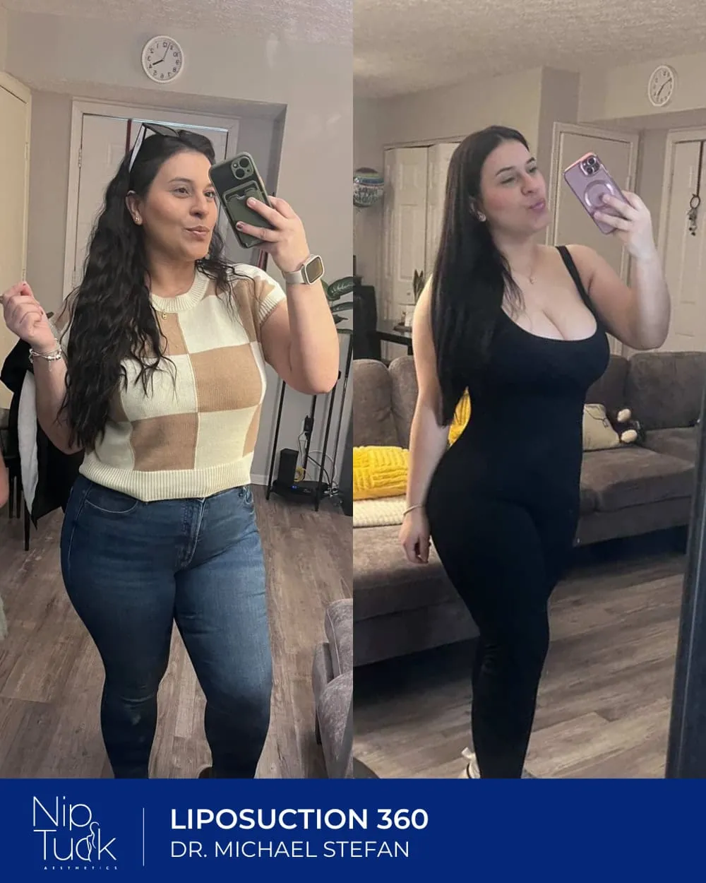 Liposuction result by Dr. Michael Stefan