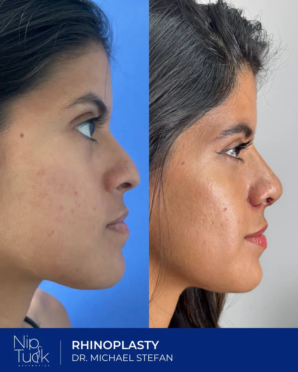 Rhinoplasty result by Dr. Michael Stefan