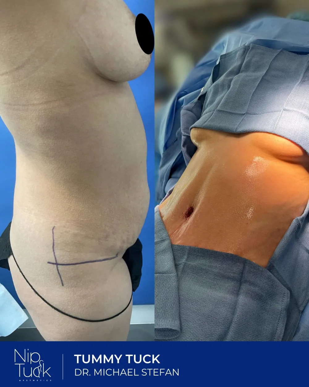 Tummy Tuck result by Dr. Michael Stefan