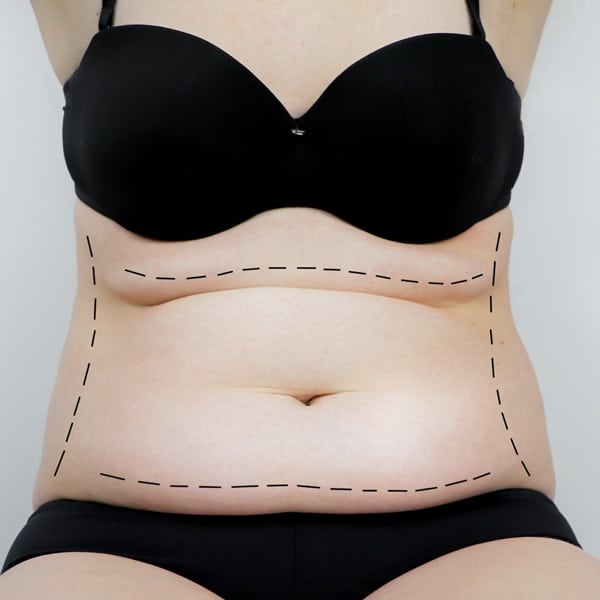 Tummy Tuck Surgery Miami